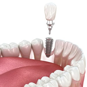 Illustration of a single dental implant