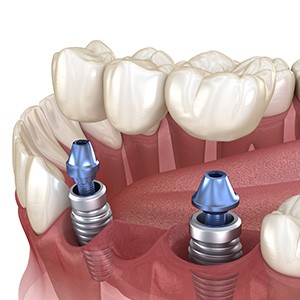 Illustration of an implant bridge