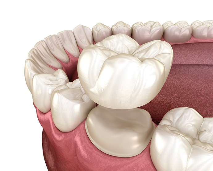 Illustration of crown being placed on tooth