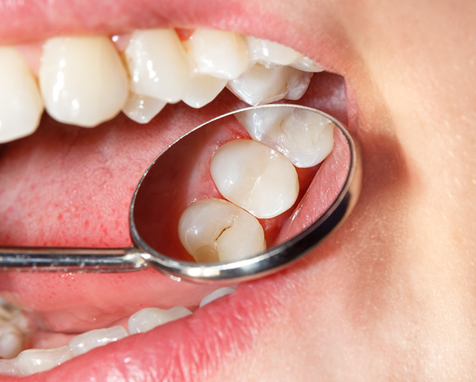 Examining smile with a dental mirror
