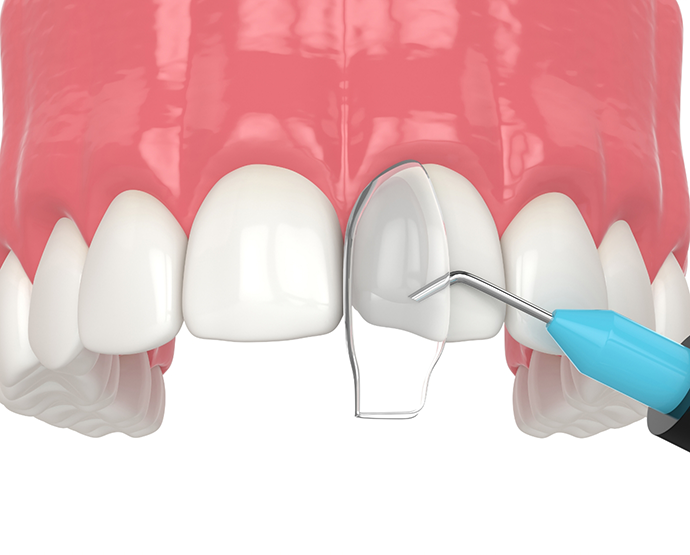 Cosmetic bonding being performed on upper teeth