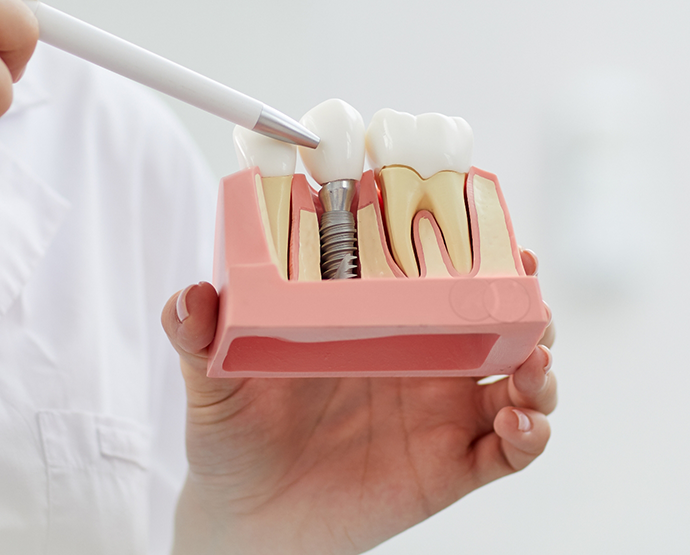Dentist holding and pointing to model of dental implant