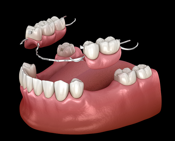 Partial dentures being placed on lower arch