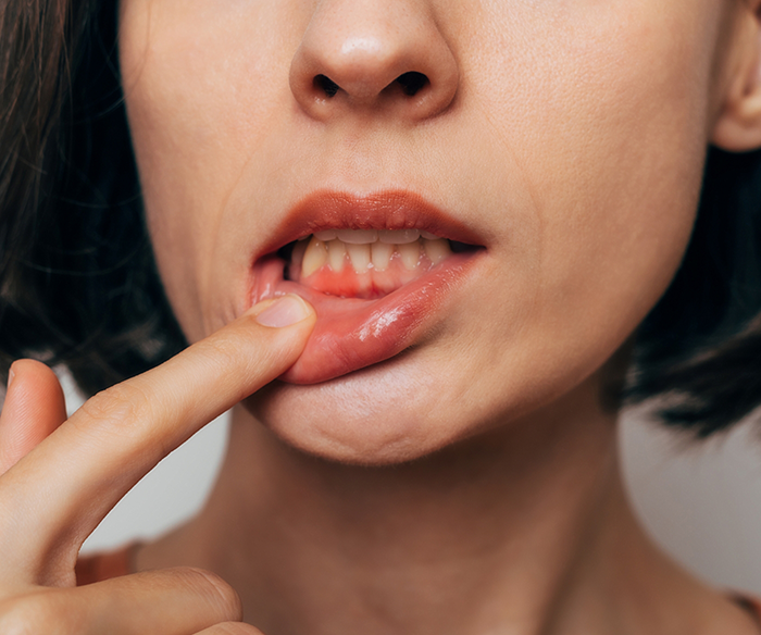 Woman pulling down lip to show signs of gum disease