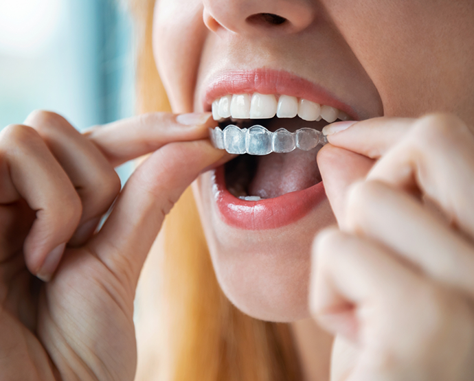 Woman putting clear aligner on teeth