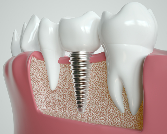 Illustration of dental implant between natural teeth