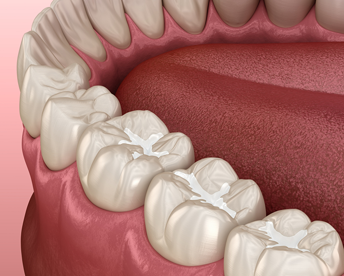 Illustration of teeth with dental sealants