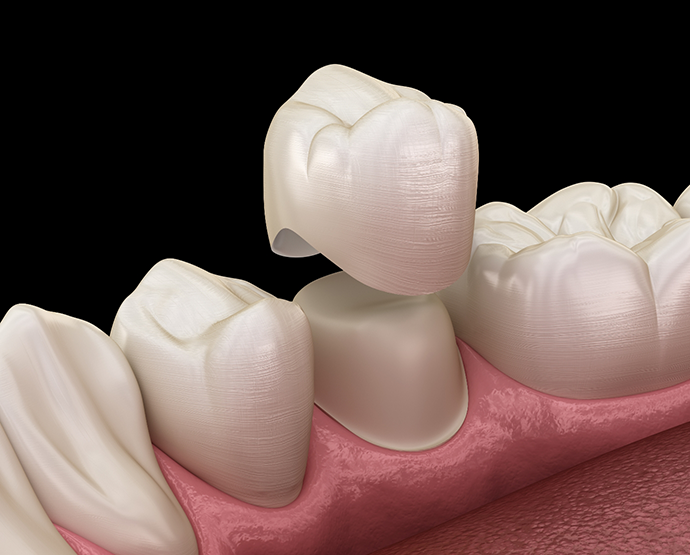 Illustration of dental crown being placed on tooth