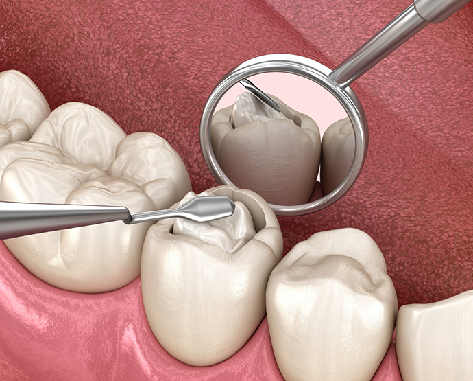 Illustration of tooth colored filling being applied