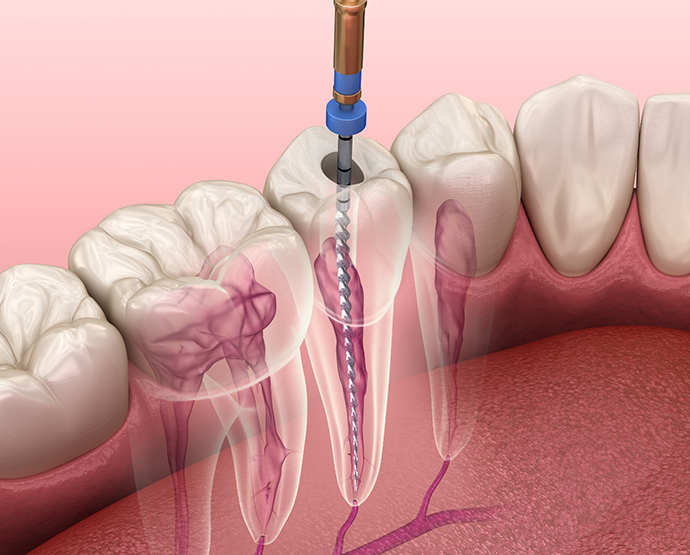 Illustration of root canal treatment in St. Augustine