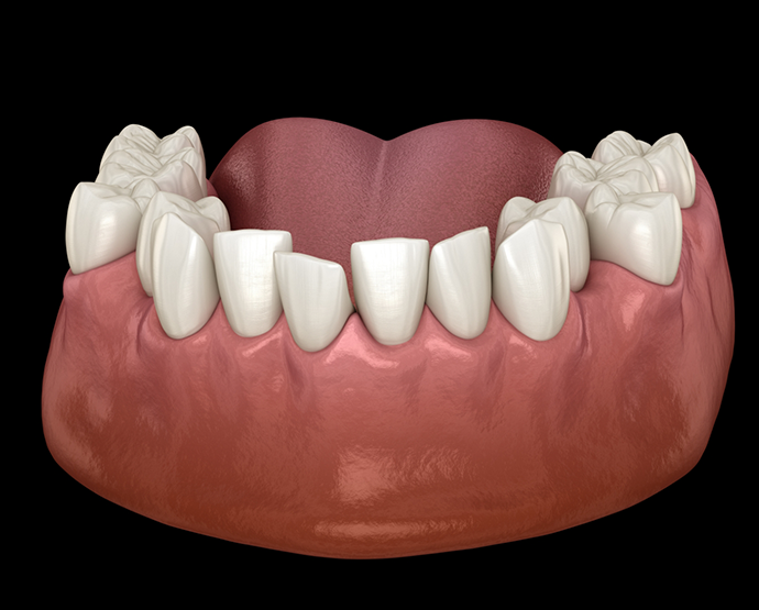 Illustration of crooked teeth