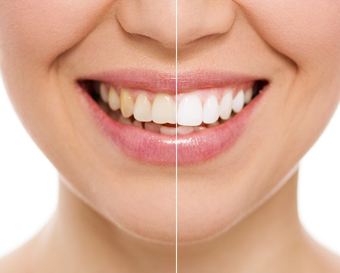 Patient in St. Augustine smile before and after teeth whitening