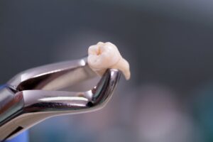Tooth being held by dental tool.