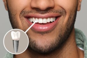 Man smiling proudly with a dental implant
